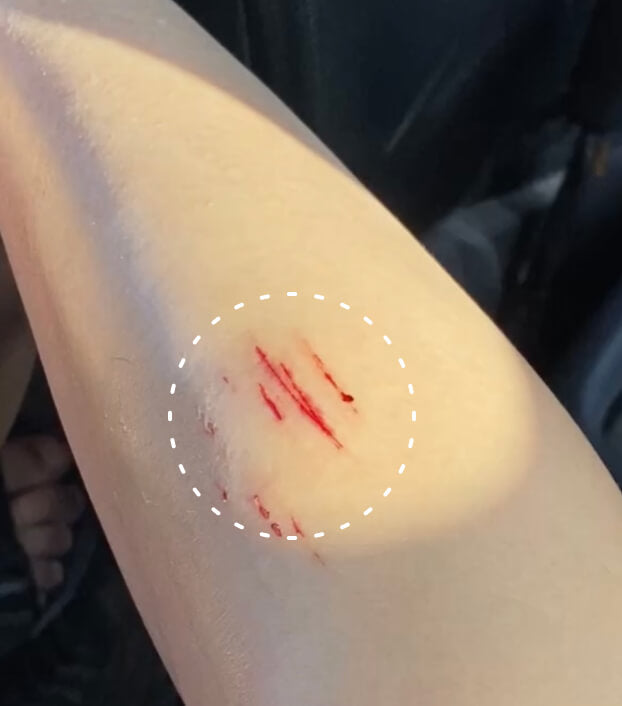Image of a person with a cut on their leg